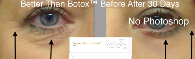 Better Than Botox After 30 Days
